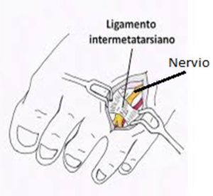 situación del ligamento intermetatarsiano