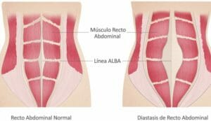 diástasis abdominal