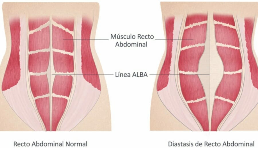 Diastásis abdominal: Qué es y otras preguntas frecuentes