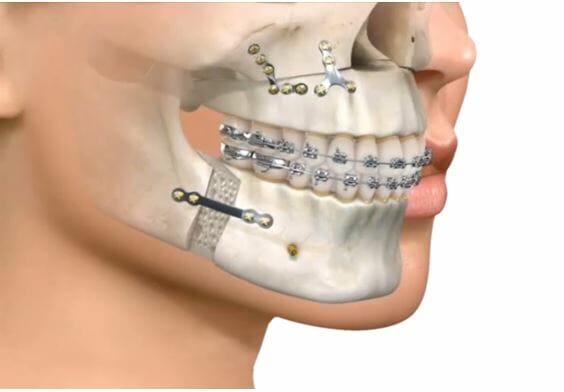 Cirugía ortognática ¿Cuáles son sus secuelas?