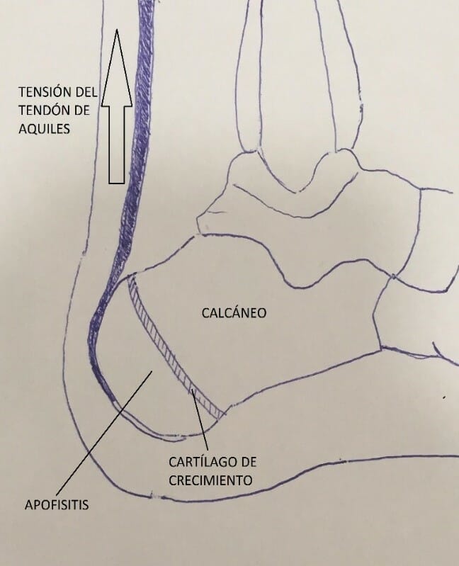 Caso clínico podología pediátrica: Enfermedad de Sever