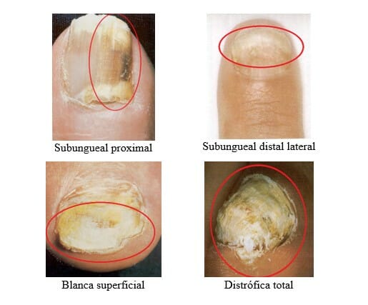 infeccion-hongos-uñas-onicomicosis-Premium