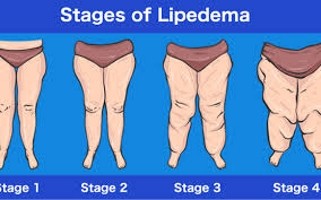 ¿Qué es el Lipedema?