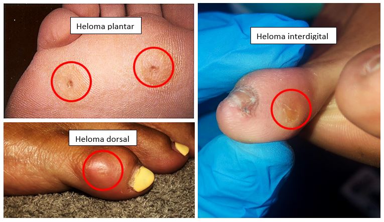 Helomas generalidades tratamiento prevencion