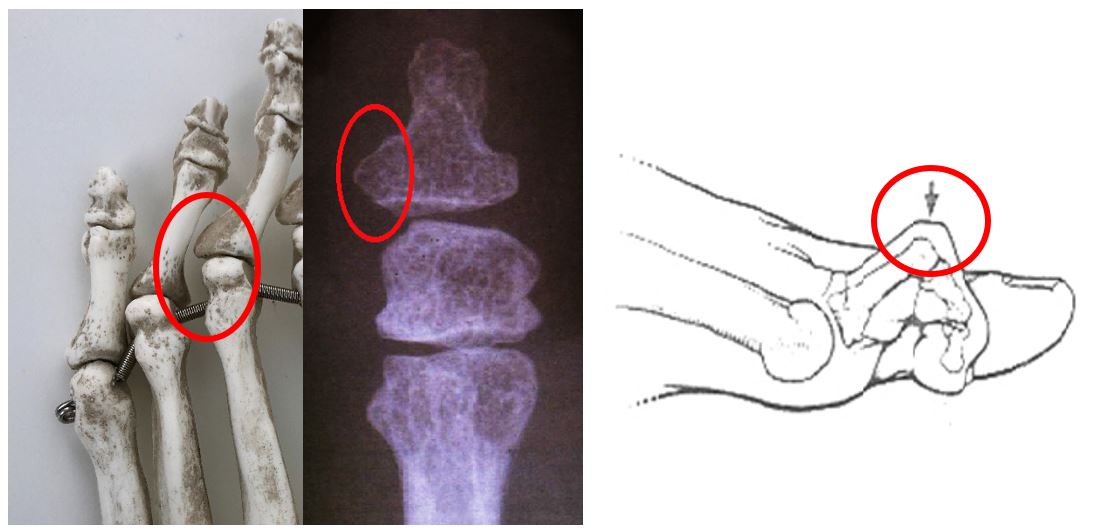 Helomas tratamiento