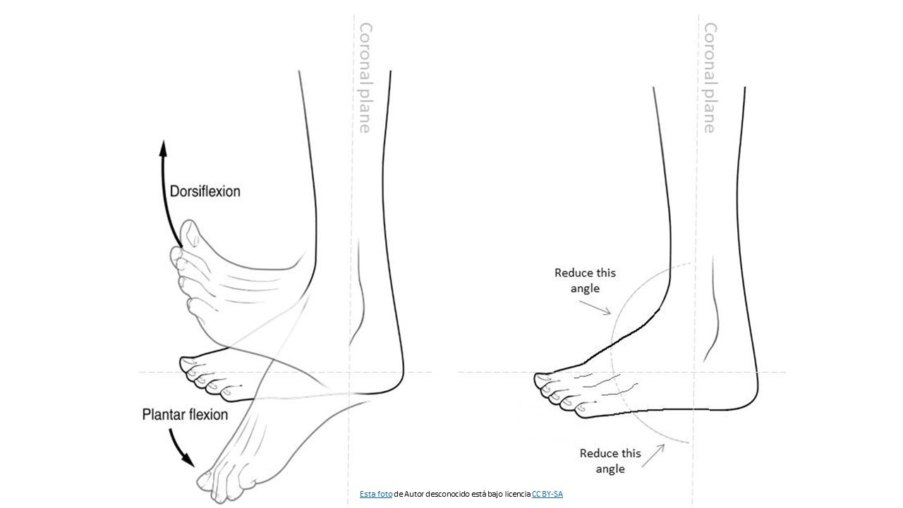 Importancia de la dorsiflexión de tobillo