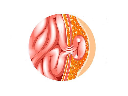 Hernia abdominal e inguinal. Una cuestión de presión