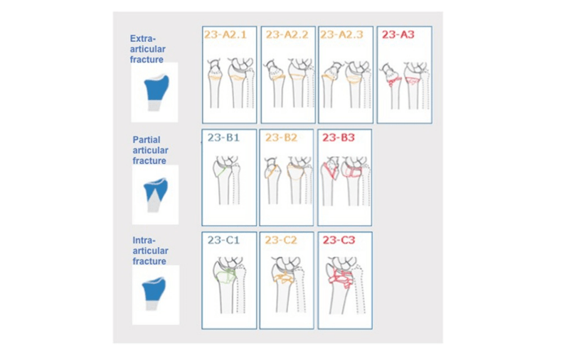 tipos de fracturas de Colles