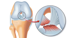 Rotura del ligamento cruzado anterior