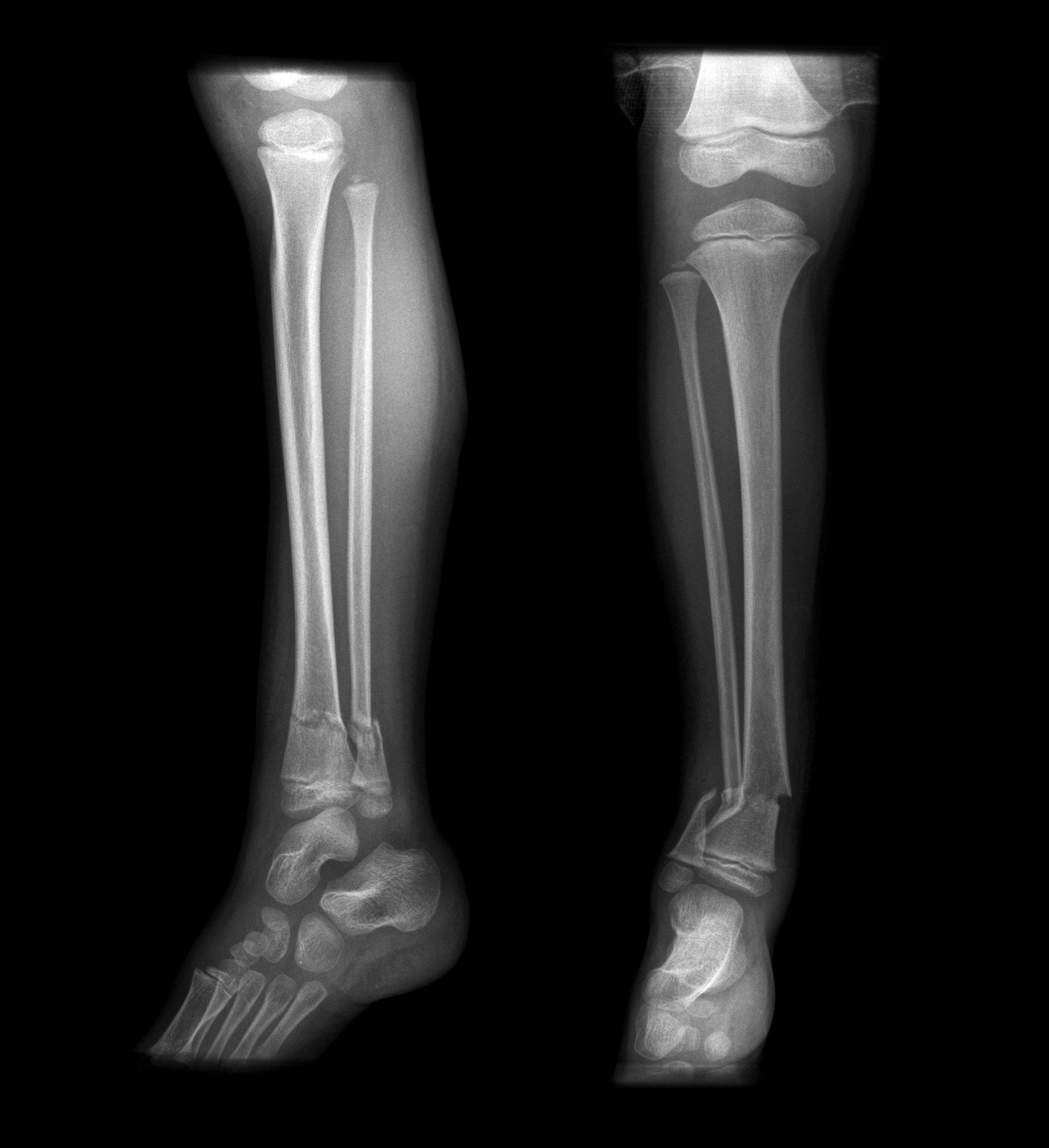 Fractura de tibia: causas, diagnóstico y tratamiento