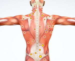 síndrome de dolor miofascial