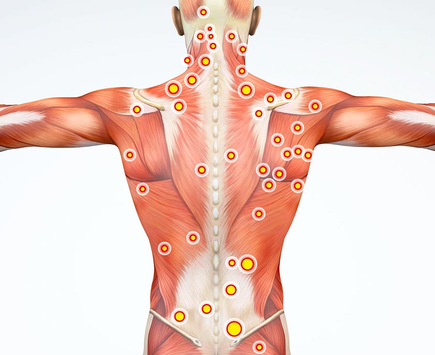 Síndrome de dolor miofascial y fisioterapia