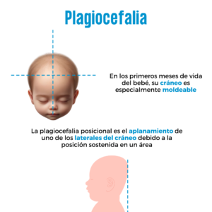 Plagiocefalia posicional