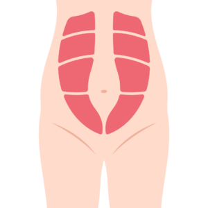 Diástasis abdominal