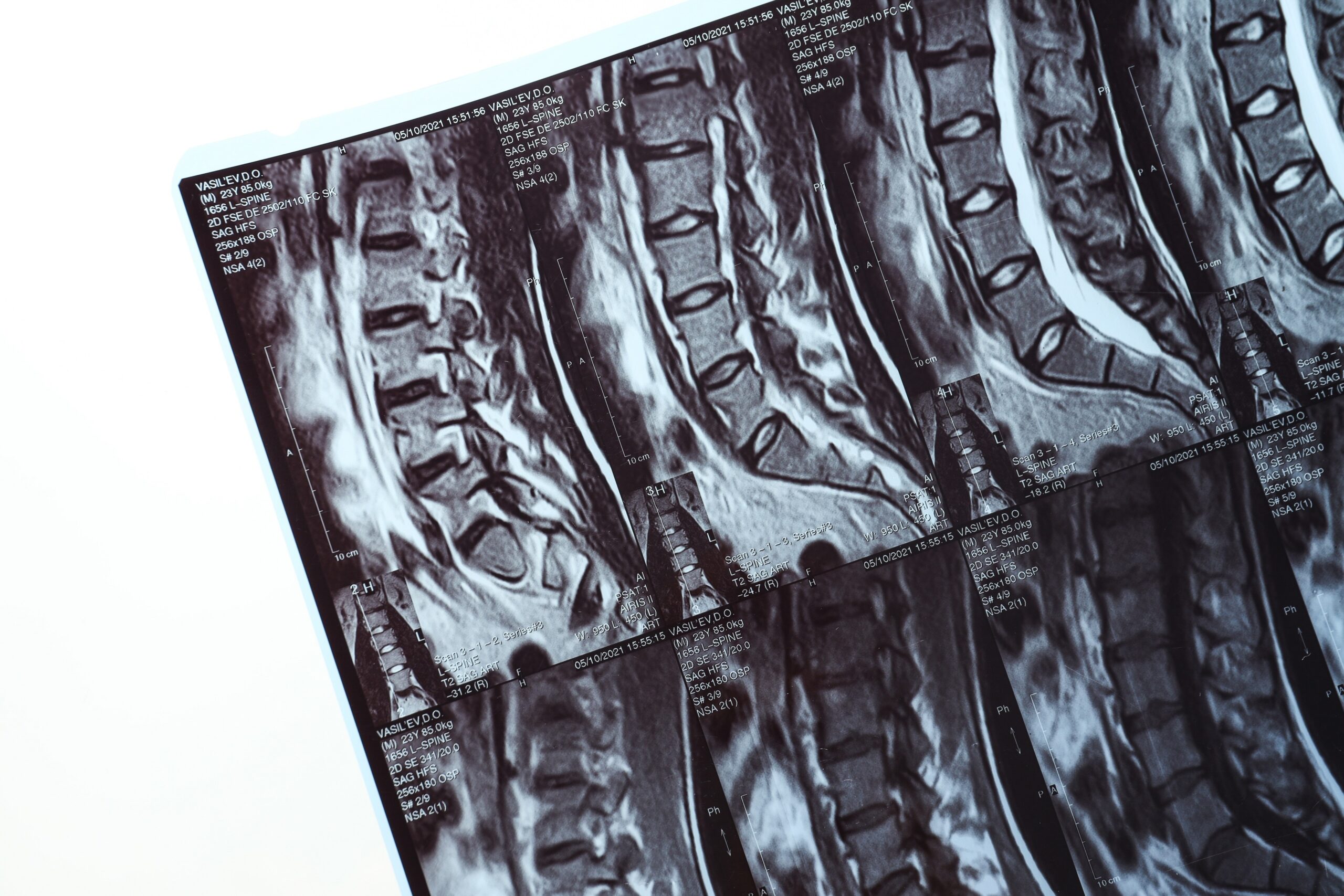 Artrodesis lumbar: ¿cuándo es realmente necesaria y qué alternativas existen?