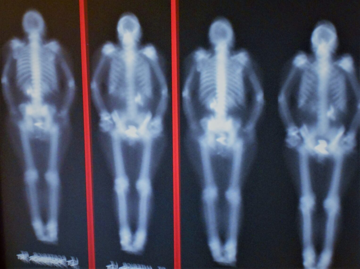 Micronutrientes para la salud ósea: claves para prevenir la osteoporosis